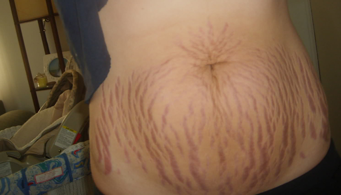 Pregnancy Stretch Marks