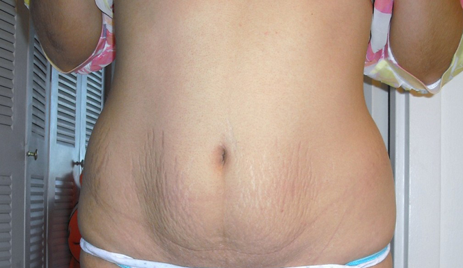 Loose-Skin-After-Pregnancy